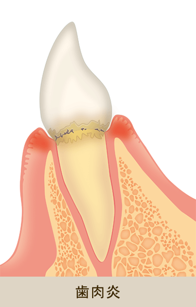 歯肉炎