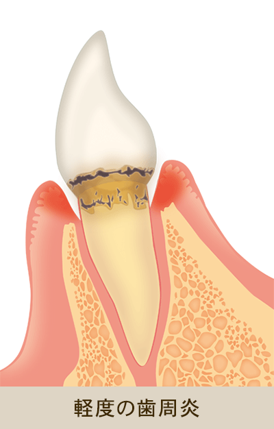 軽度の歯周炎