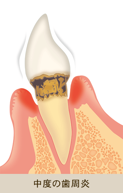 中度の歯周炎