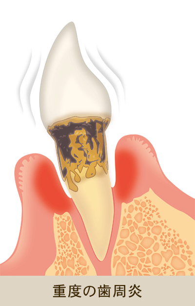 重度の歯周炎